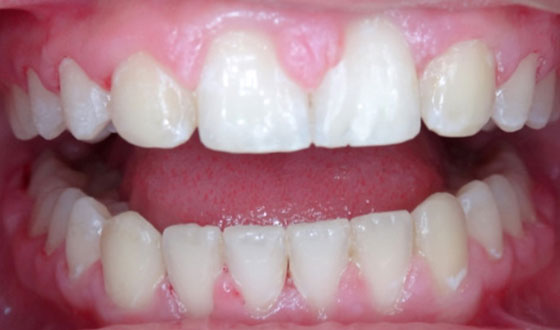 img-braces-after