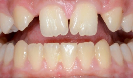 img-braces-before