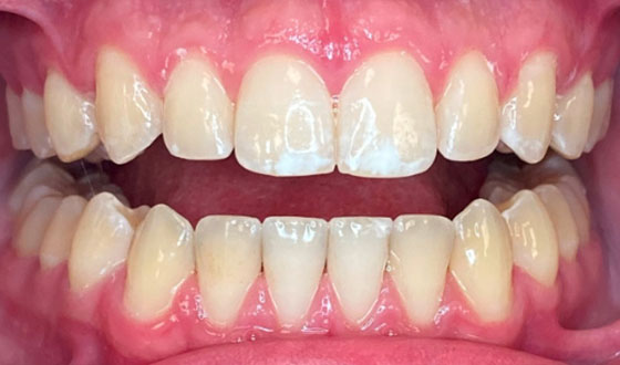 img-invisalign-after