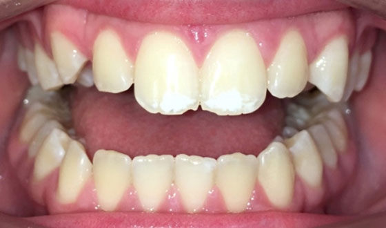 img-invisalign-before