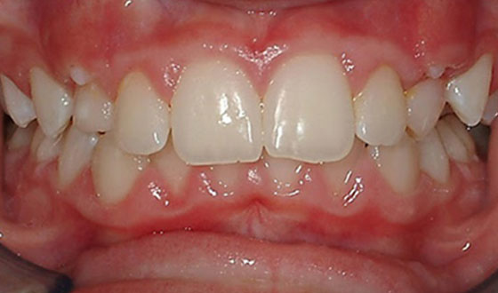 img-palatalexpansion-after
