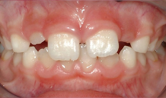 img-palatalexpansion-before